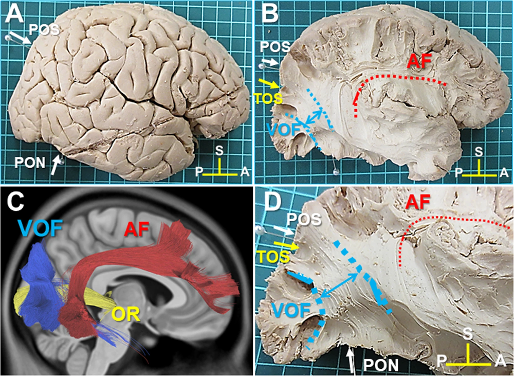 Illustration de trois faisceaux de fibres: les radiations optiques (OR), le faisceau arquée (AF) et le faisceau occipital vertical (VOF). Les faisceaux sont présentés sur différentes vues d’une dissection (A, B, D), ainsi qu’à l’aide d’une dissection virtuelle (C). Figure tirées de , sous licence CC-BY 4.0.