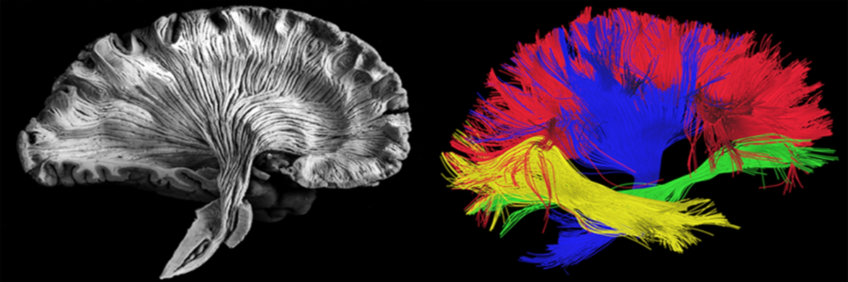À gauche, une coupe de cerveau post-mortem préparée pour mettre en valeurs les faisceaux de fibres de matière blanche. À droite, une dissection virtuelle des faisceaux de matière blanche générée grâce à des données d’IRM de diffusion. Image shutterstock ID 412065940.