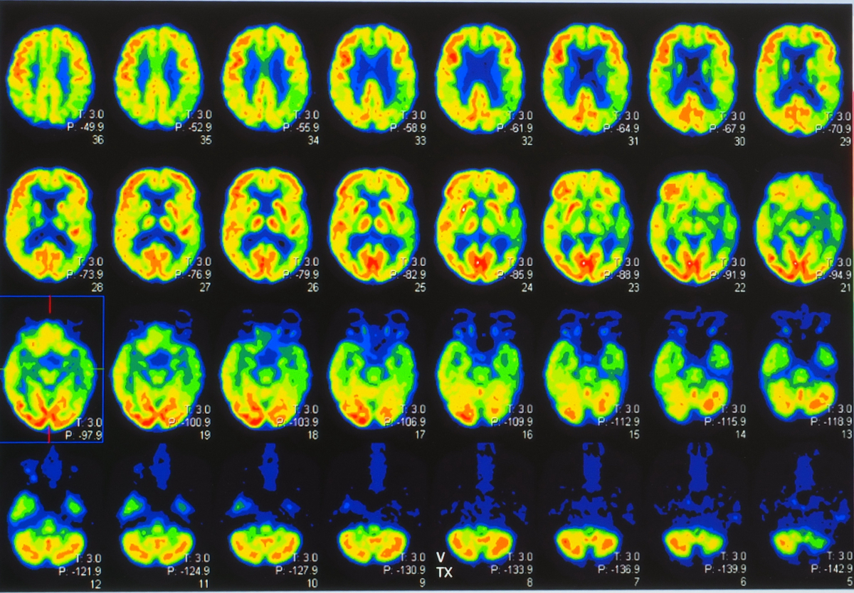 Montage de coupes axiales d’un scanner TEP avec un radiotraceur FDG, illustrant le niveau d’activité métabolique du glucose durant la durée du scan. Image shutterstock ID 1342194254.