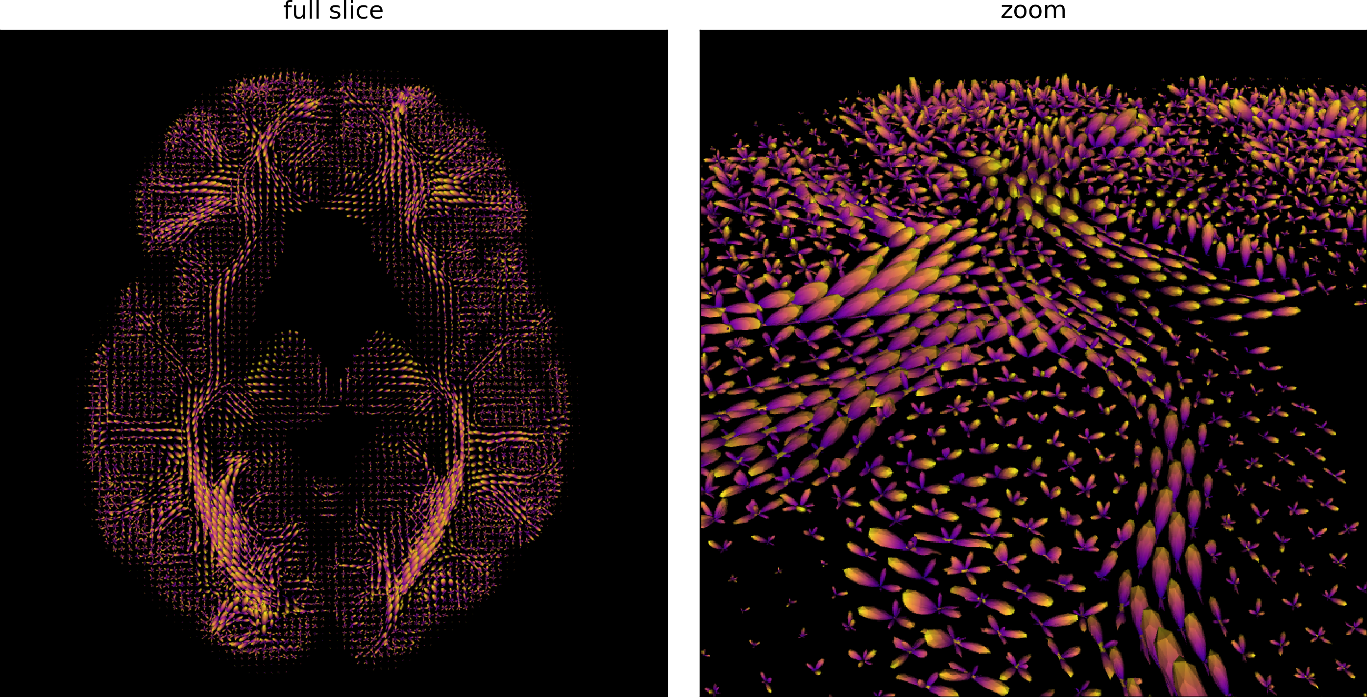 Estimation de fODF sur une coupe axiale (gauche) et zoom sur une portion de la coupe (droite). Figure générée par du code python adapté d’un tutoriel Dipy par P. Bellec sous licence CC-BY 4.0.