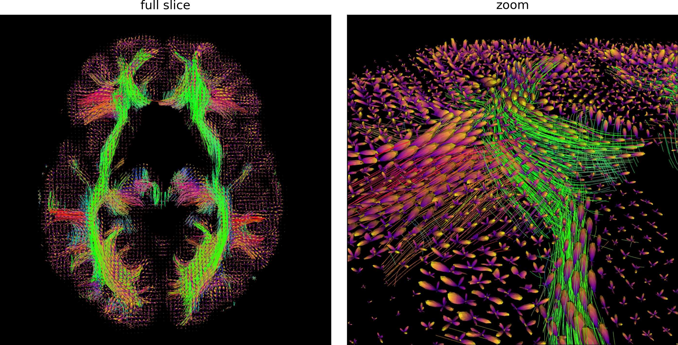 Fibres reconstruites par une approche streamline déterministe avec une approche multi-tenseurs, qui permet de suivre plusieurs pics de diffusion à chaque voxel, à partir de l’ensemble des points dans la matière blanche sur une coupe axiale (gauche) et zoom sur une portion de la coupe (droite). Cette approche permet d’être plus robuste à la présence de croisement de fibres. Figure générée par du code python adapté d’un tutoriel Dipy par P. Bellec sous licence CC-BY 4.0.