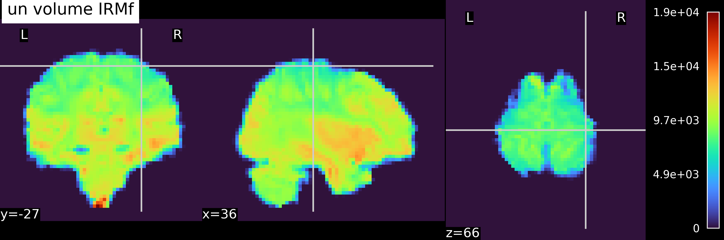 Exemple d’un unique volume dans une série IRMf. Le volume est représenté sur trois plans de coupes: coronal (gauche), sagittal (milieu) et axial (droite). Voir l’astuce Naviguer à travers les coupes du cerveau pour une explication de ces termes. Remarquez que la résolution du volume est bien moins élevée que pour l’IRM anatomique, et que l’on a beaucoup de mal à voir les détails de l’anatomie du cerveau. Cette figure est générée par du code python à l’aide de la librairie nilearn à partir d’un jeu de données public appelé ADHD200  (cliquer sur + pour voir le code).