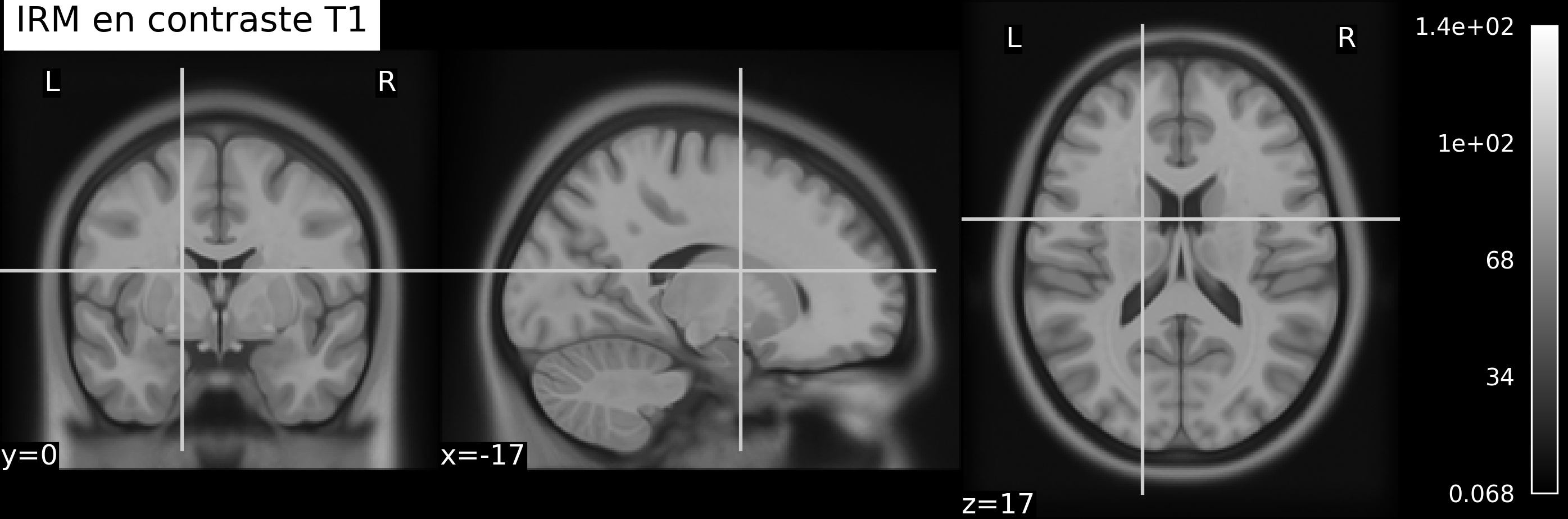 Un exemple d’IRM structurelle (ici avec un contraste dit T1), sur trois plans de coupes: coronal (gauche), sagital (milieu) et axial (droite). Voir l’astuce Naviguer à travers les coupes du cerveau pour une explication de ces termes. Cette figure est générée par du code python à l’aide de la librairie nilearn à partir d’un jeu de données public appelé template MNI152 2009  (cliquer sur + pour voir le code).