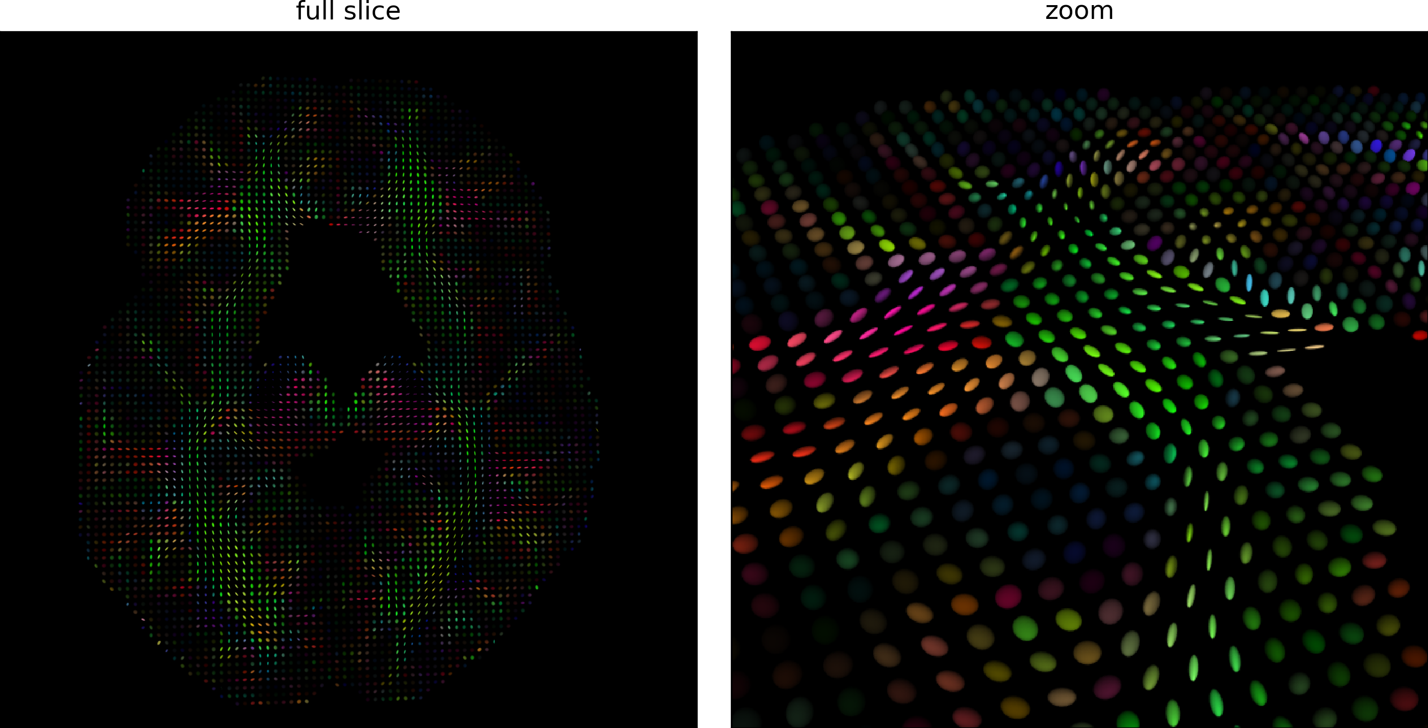 Tenseurs de diffusion estimés sur une coupe axiale (gauche) et zoom sur une portion de la coupe (droite). La couleur de chaque tenseur code pour la direction principale de diffusion, ainsi que l’anisotropie fractionnelle de chaque tenseur. Les tenseurs les plus brillants sont fortement anisotropes, c’est-à-dire que la direction principale de diffusion est nettement plus forte que les directions transverses. Figure générée par du code python adapté d’un tutoriel Dipy par P. Bellec sous licence CC-BY 4.0.