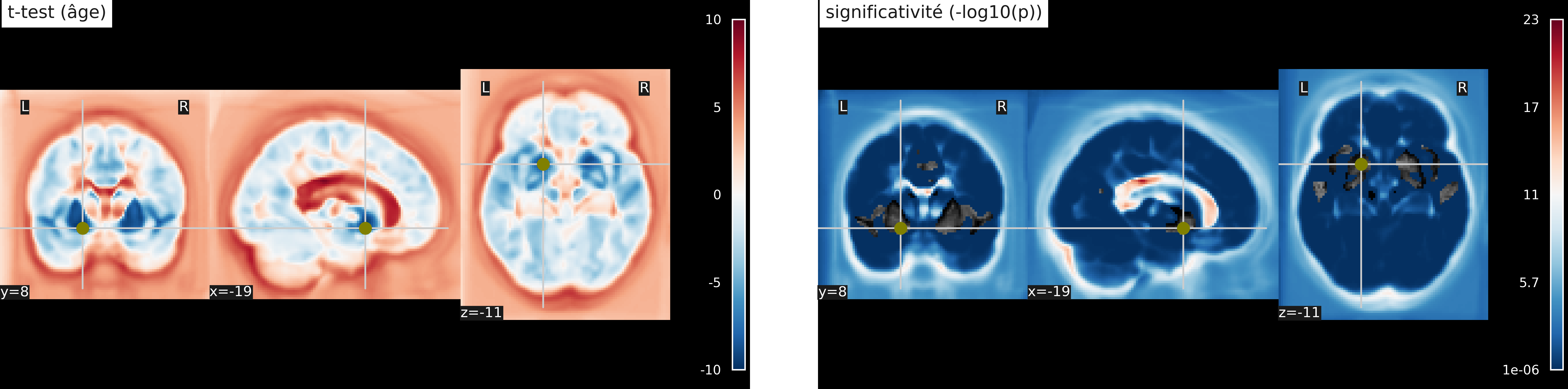 Tests statistiques sur la significativité de l’association entre densité de matière grise et âge. Test t de Student (haut) et log10(p) (bas). Cette figure est adaptée d’un tutoriel de la librairie nilearn (cliquer sur + pour voir le code). Cette figure est distribuée sous licence CC-BY 4.0.